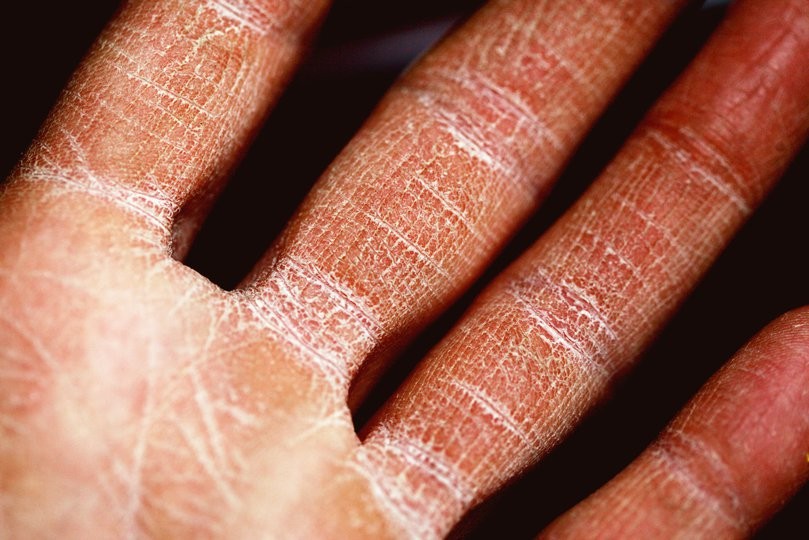 Schwer geschädigte Haut an der Hand einer Person